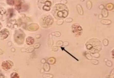 白带香蕉视频免费APP厂家分析白带常规检查及临床意义