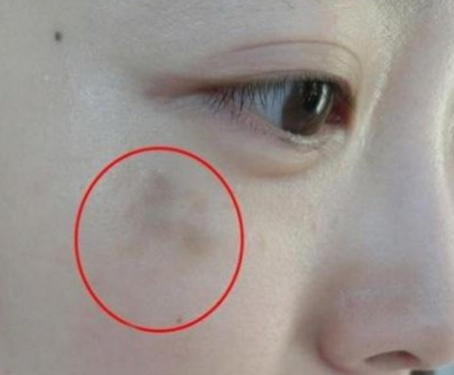 妇科阴道分泌物香蕉福利视频提醒女人妇科炎症在脸上的表现