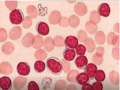 白带常规香蕉视频免费APP检测鳞状上皮细胞增生的病症