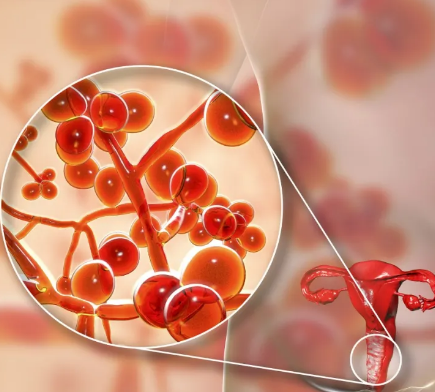 【全自动白带香蕉视频免费APP】厂家山东香蕉视频官网提醒阴道炎反反复复的4个误区